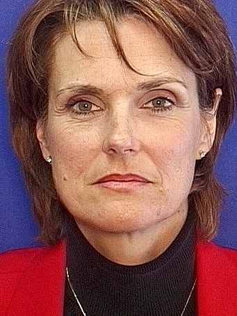 Brow Lift Before & After