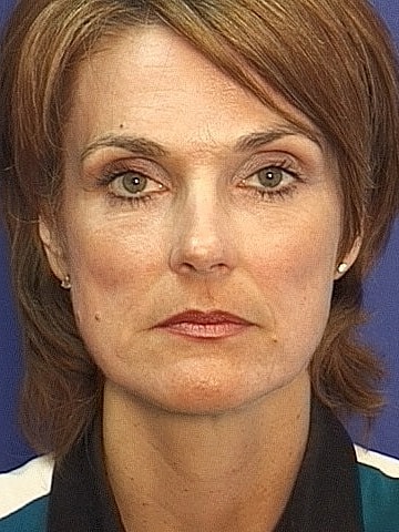 Brow Lift Before & After