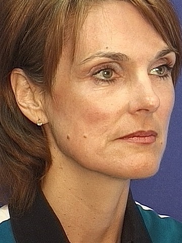 Brow Lift Before & After