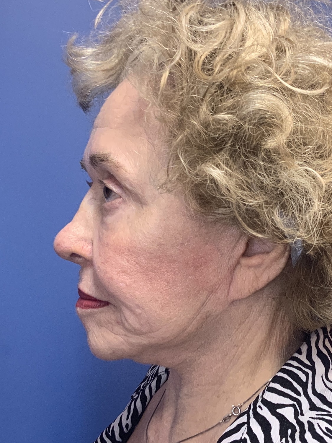 Brow Lift Before & After