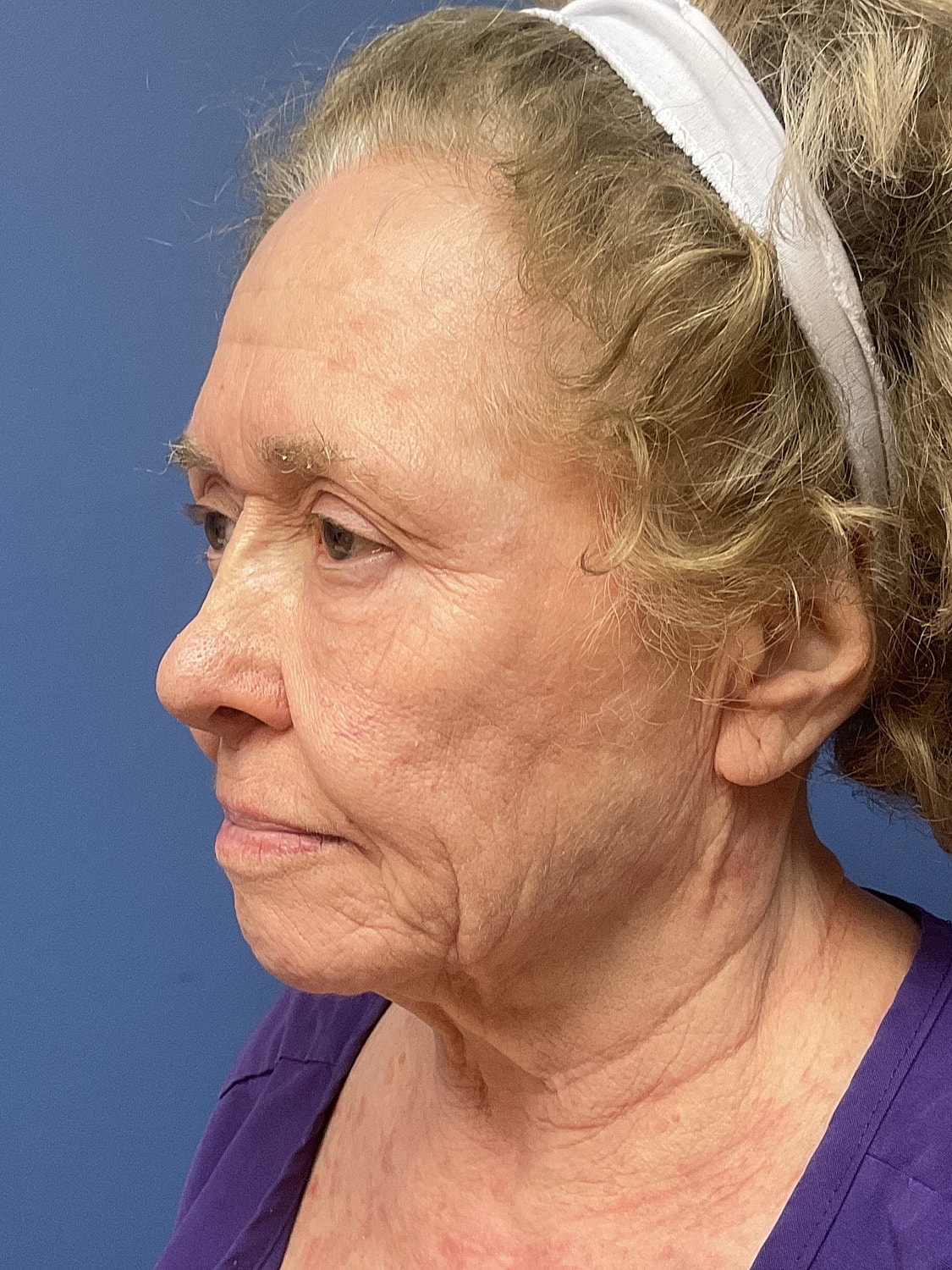 Brow Lift Before & After