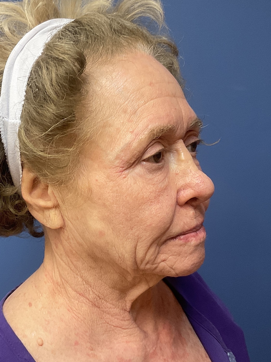 Brow Lift Before & After