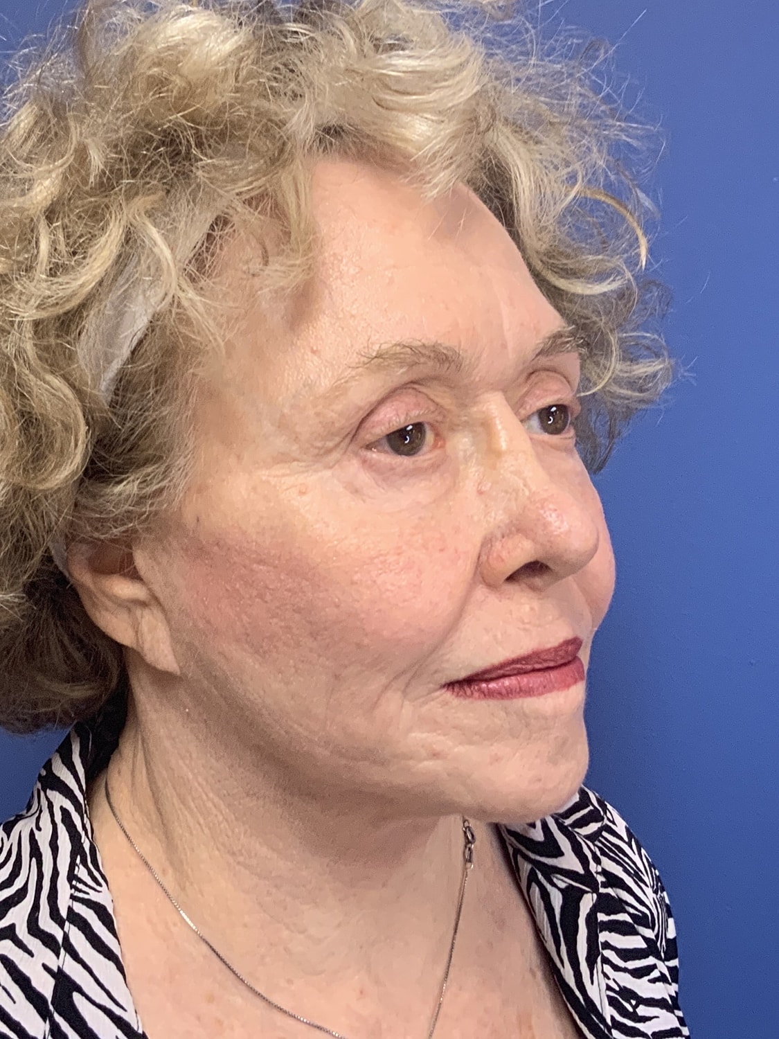 Brow Lift Before & After