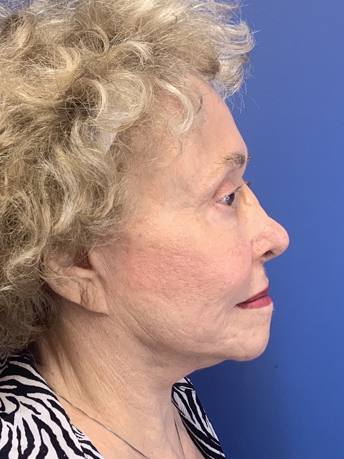 Brow Lift Before & After