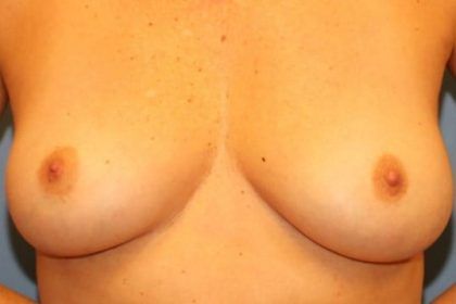 Breast Implant Removal Before & After