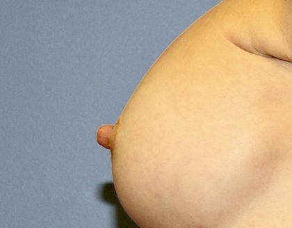 Nipple Reduction Before & After
