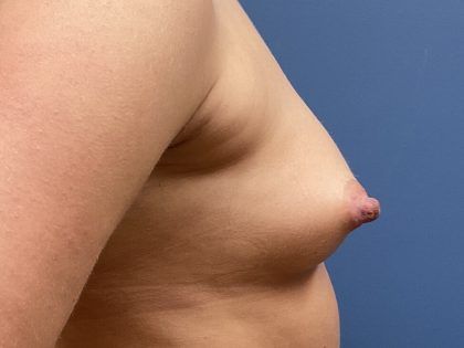 Nipple Reduction Before & After