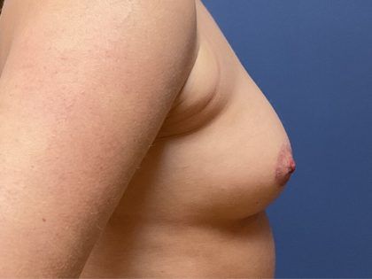 Nipple Reduction Before & After