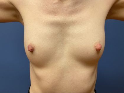 Nipple Reduction Before & After