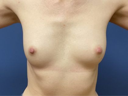 Nipple Reduction Before & After