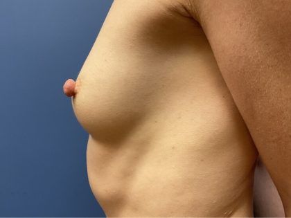 Nipple Reduction Before & After