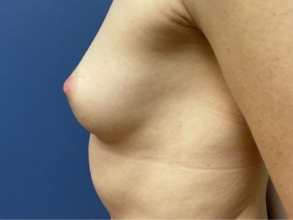 Nipple Reduction Before & After