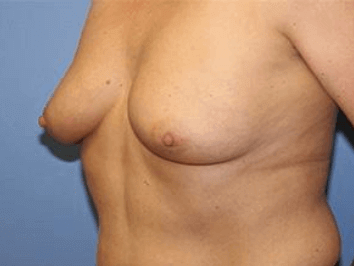 Breast Lift Before & After