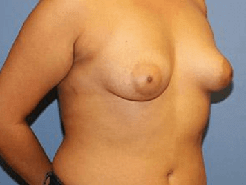 Breast Lift Before & After