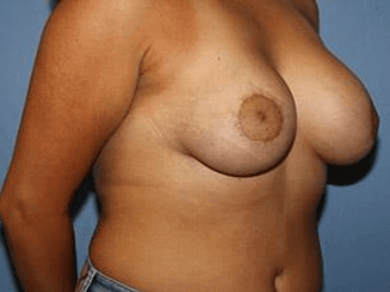 Breast Lift Before & After