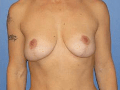 Breast Lift Before & After