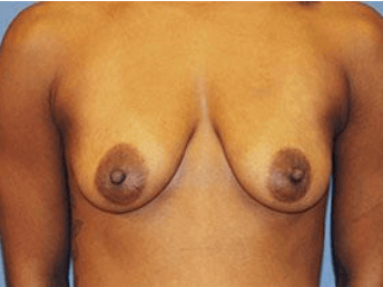 Breast Lift Before & After