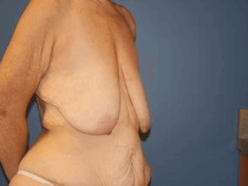 Breast Lift Before & After