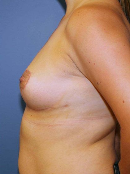 Breast Lift Before & After