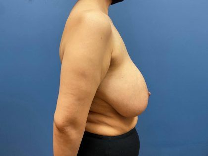Breast Lift Before & After
