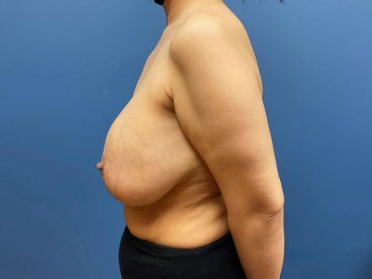Breast Lift Before & After