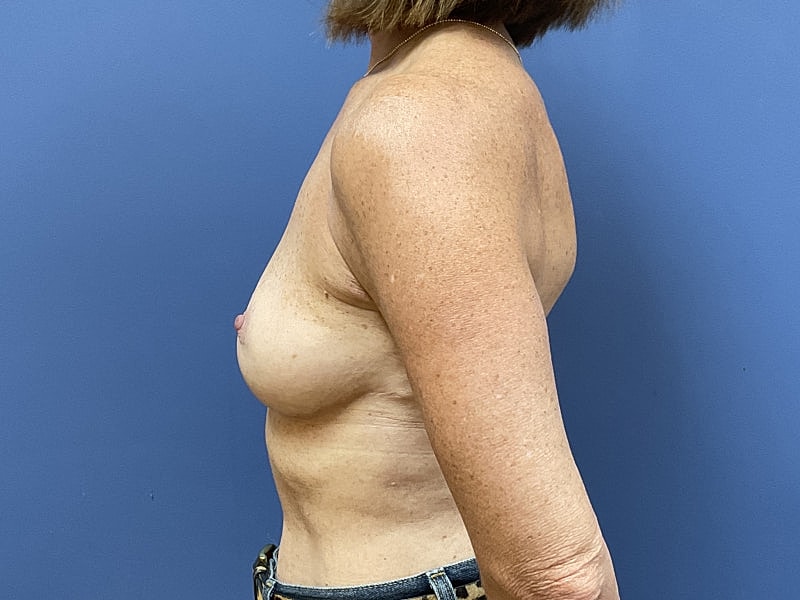 Breast Lift Before & After