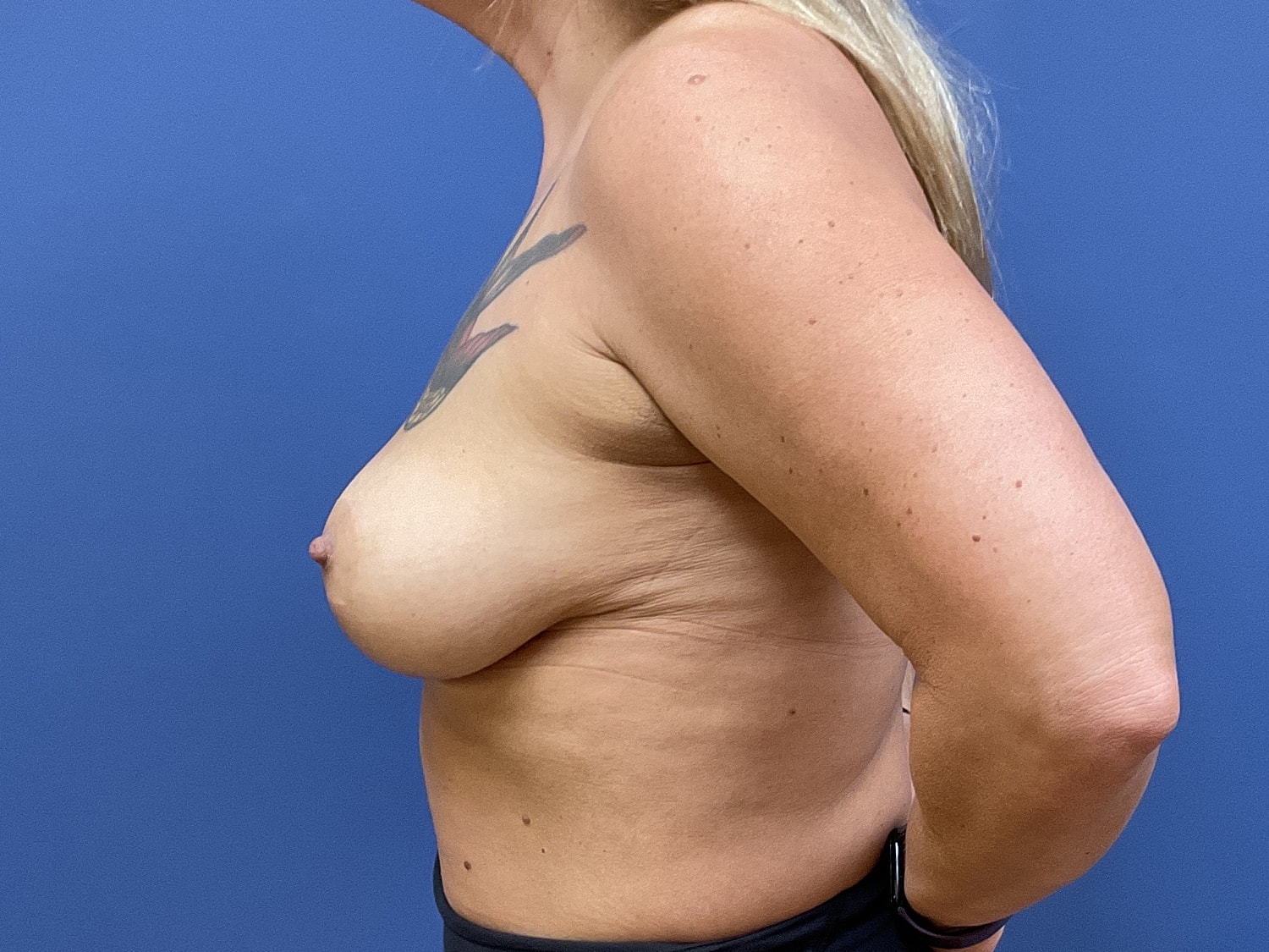 Breast Lift Before & After
