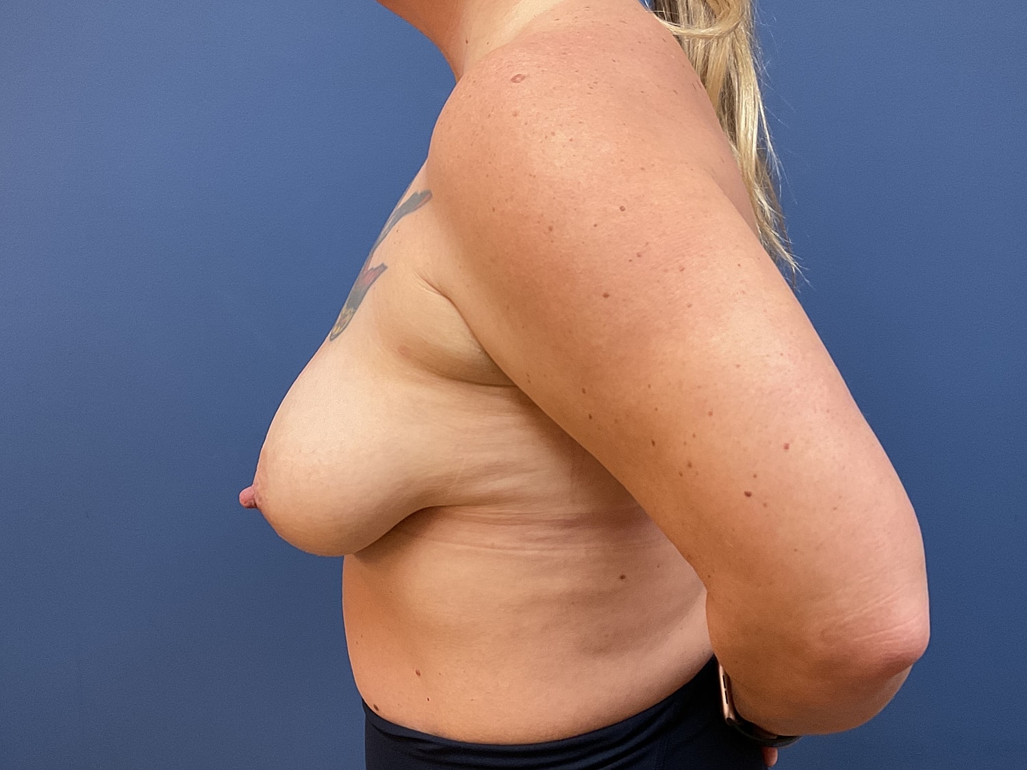 Breast Lift Before & After