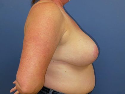 Breast Reduction Before & After