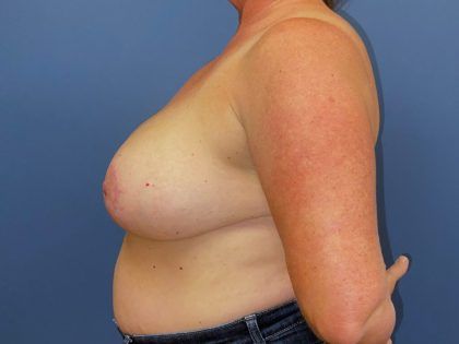 Breast Reduction Before & After