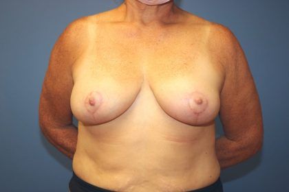 Breast Reduction Before & After