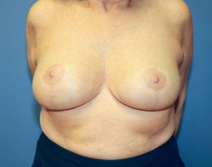 Breast Reduction Before & After