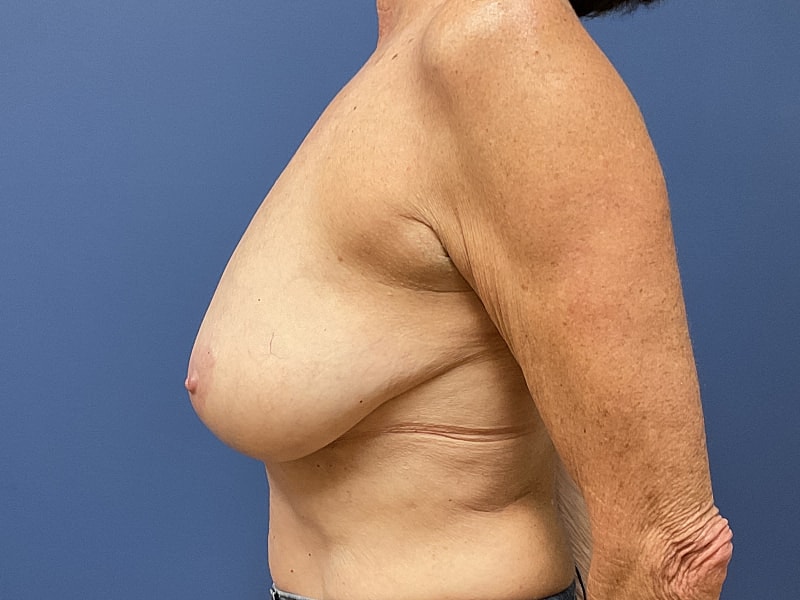 Breast Reduction Before & After