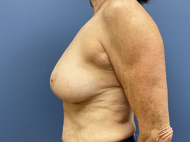 Breast Reduction Before & After