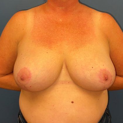 Breast Reduction Before & After