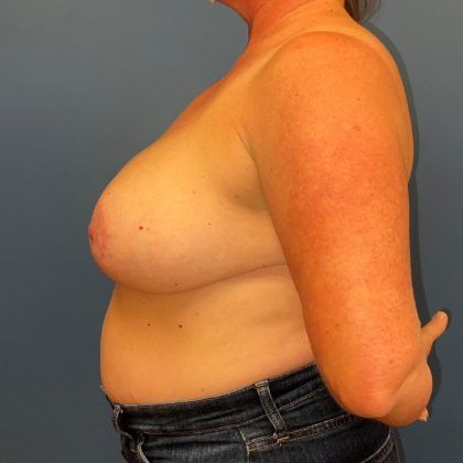 Breast Reduction Before & After