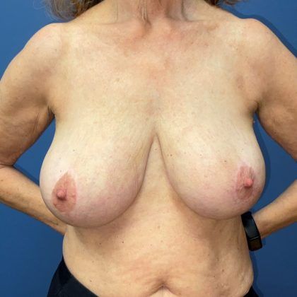 Breast Reduction Before & After