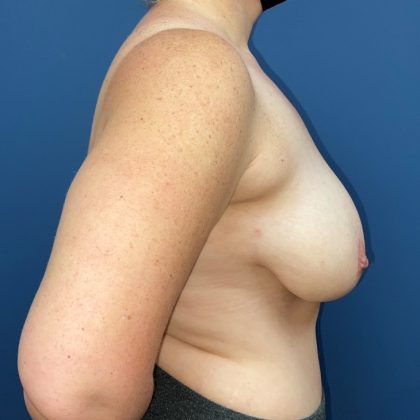 Breast Reduction Before & After