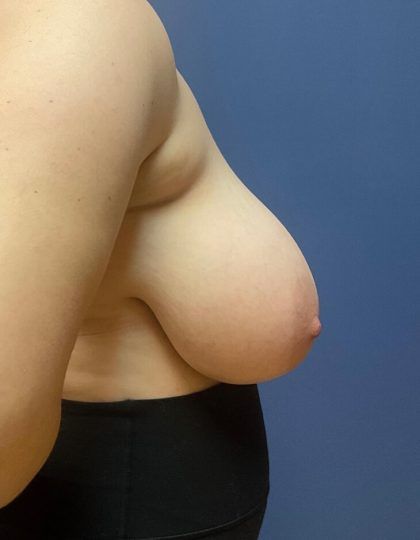 Breast Reduction Before & After