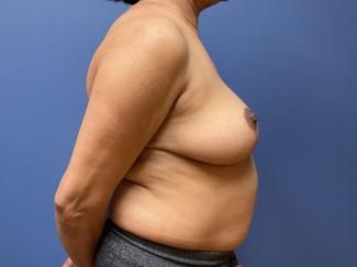 Breast Reduction Before & After
