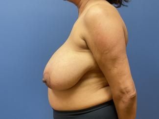 Breast Reduction Before & After