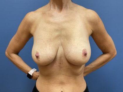 Breast Reduction Before & After