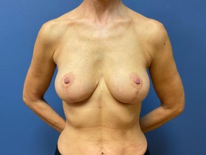 Breast Reduction Before & After