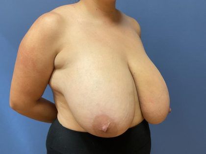 Breast Reduction Before & After