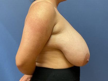 Breast Reduction Before & After