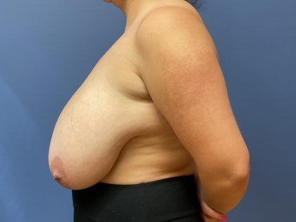 Breast Reduction Before & After