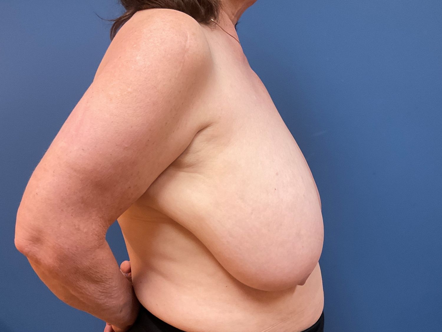 Breast Reduction Before & After