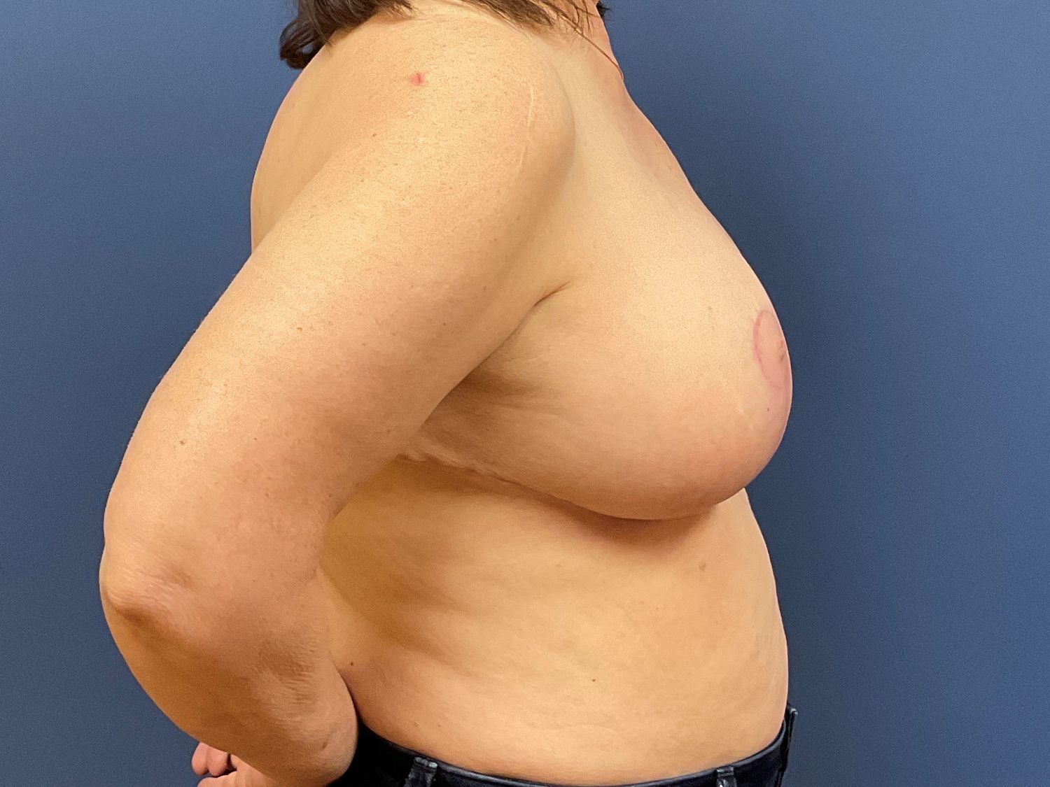 Breast Reduction Before & After