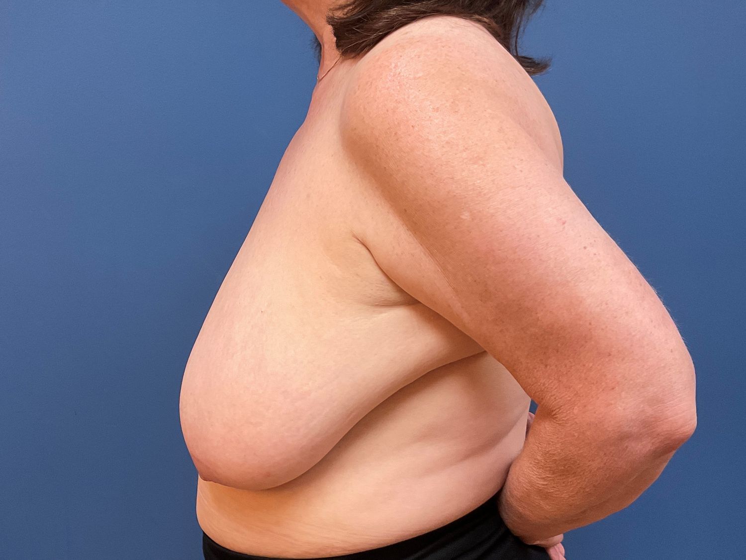 Breast Reduction Before & After