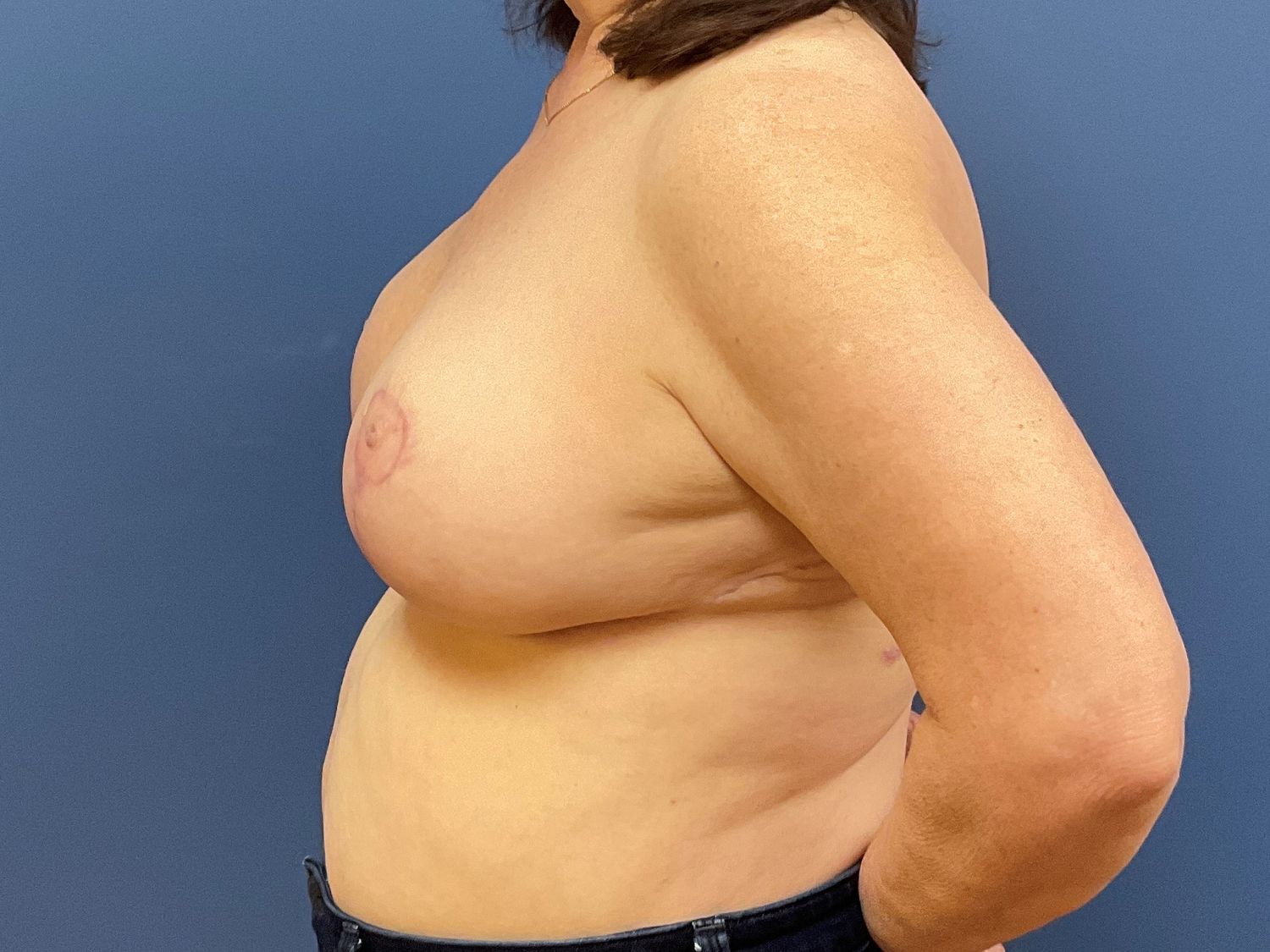 Breast Reduction Before & After